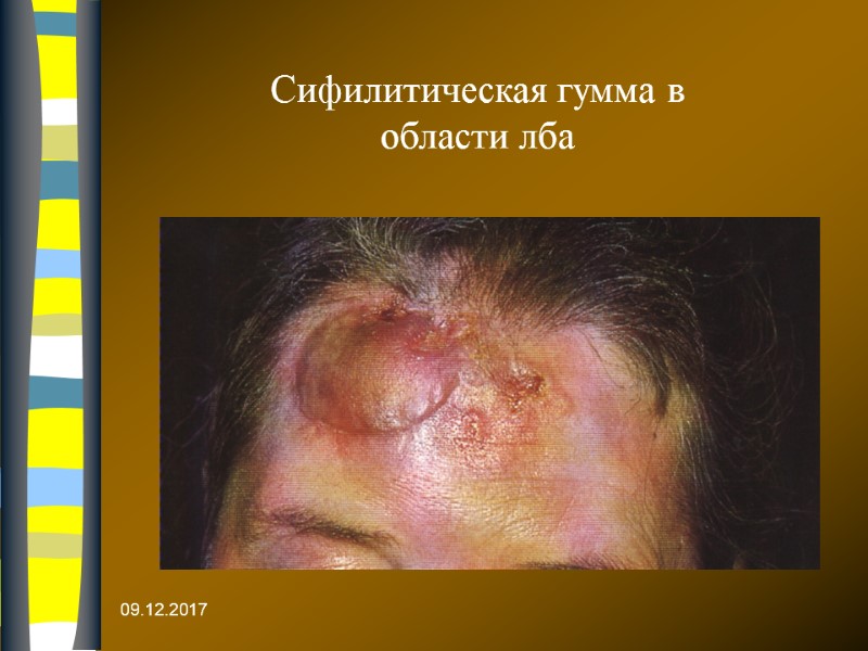 09.12.2017 Сифилитическая гумма в области лба